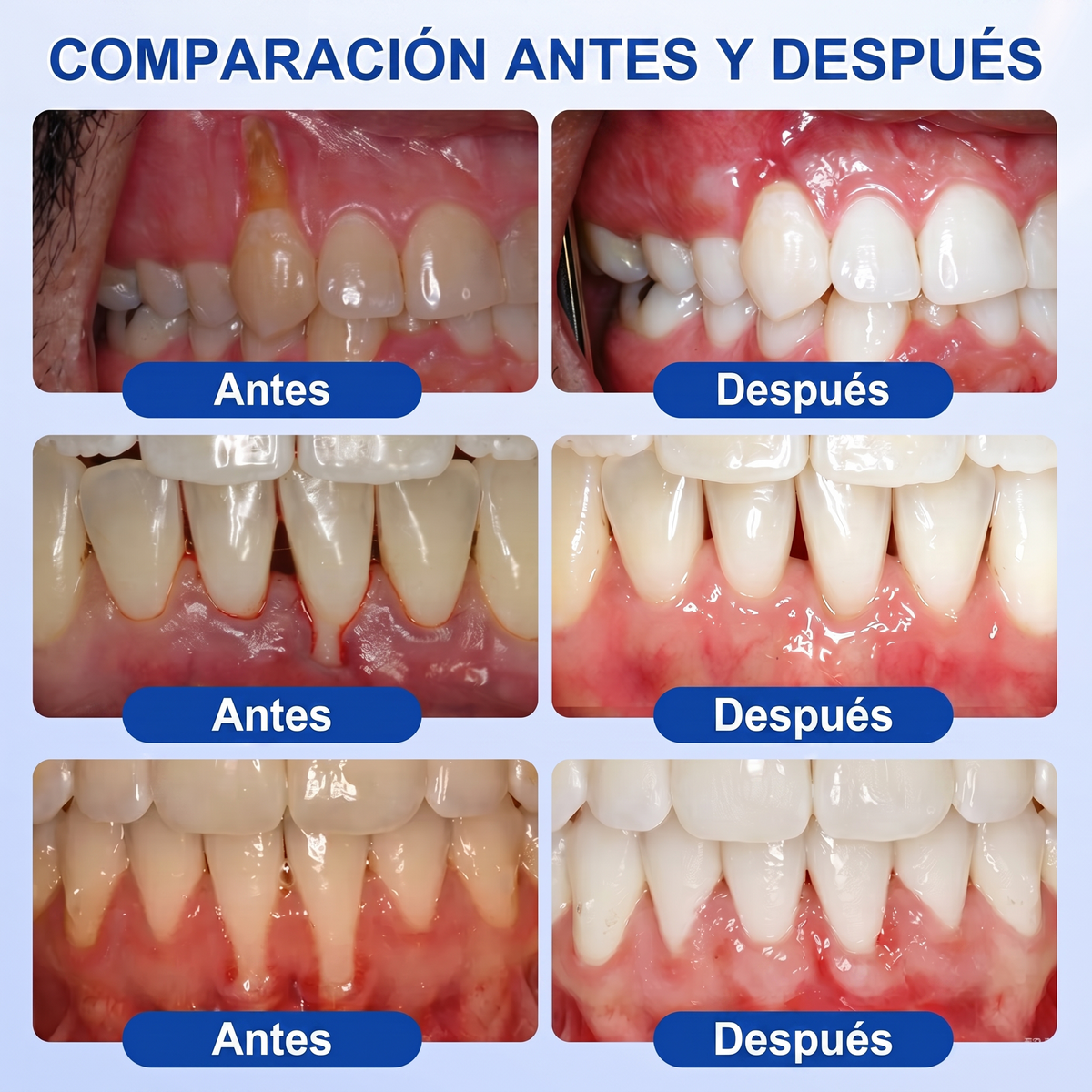 Zoencgz® 💯🍭 Gel antibacteriano para la regeneración de las encías | Resultados visibles en 7 días