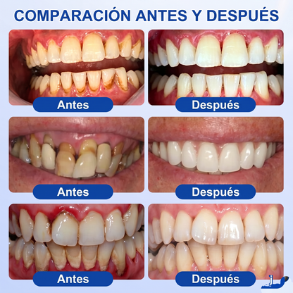 Zoencgz® 💯🍭 Gel antibacteriano para la regeneración de las encías | Resultados visibles en 7 días